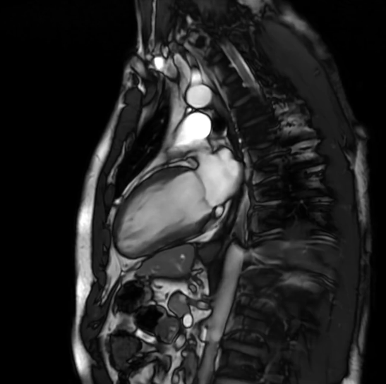 Reference 2-chamber cardiac MRI view showing the LV long axis from apex to mitral valve