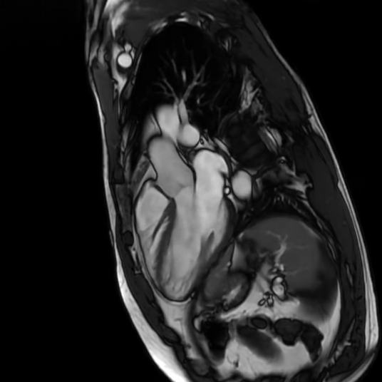 3 Chamber cardiac MRI view