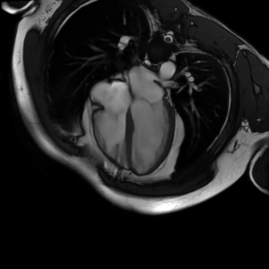 4 Chamber cardiac MRI view
