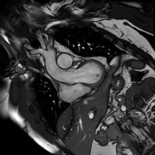 LVOT cardiac MRI view