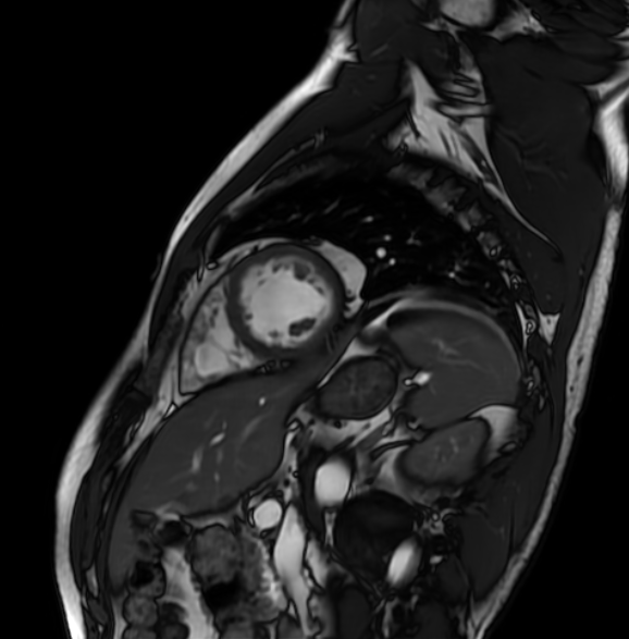 Short Axis cardiac MRI view